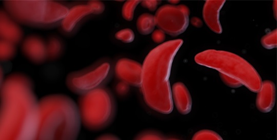 Sickle Cell 101: Increasing Awareness and Understanding