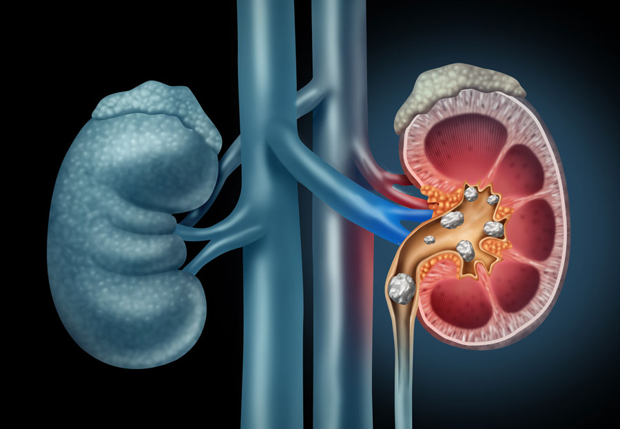 Early Detection of Chronic Kidney Disease, often called a “silent
