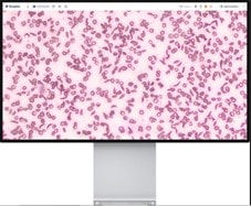 Scopio sickle cell