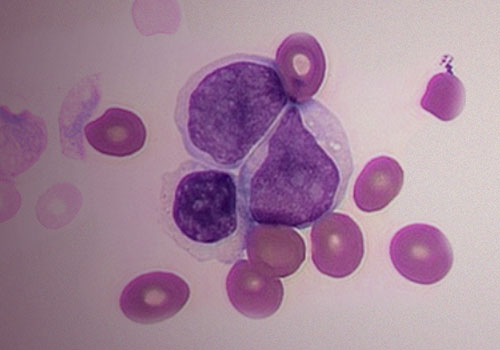 Understanding Acute Myeloid Leukemia