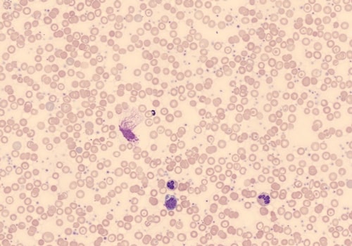 Microcytic Anemia Factor