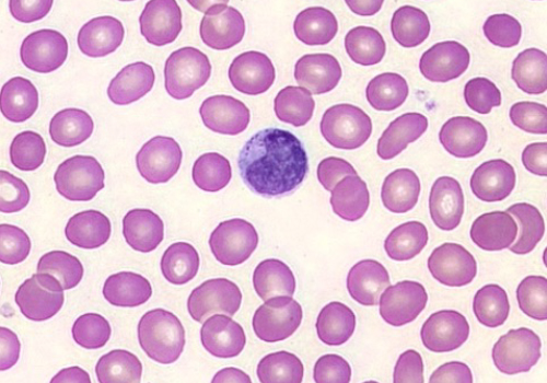 Hematology Clinical Parameters Monocyte Distribution Width (MDW)