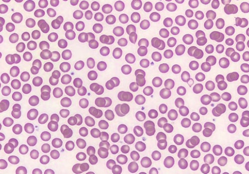 Hematology Clinical Parameter Mean Platelet Volume (MPV)
